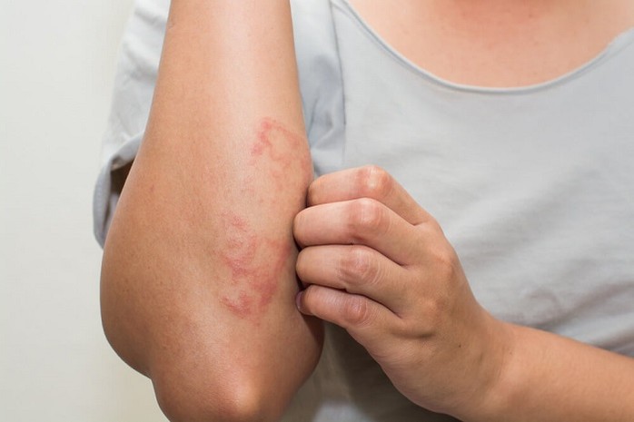 Các bệnh mùa nắng nóng thường gặp và cách phòng ngừa hiệu quả