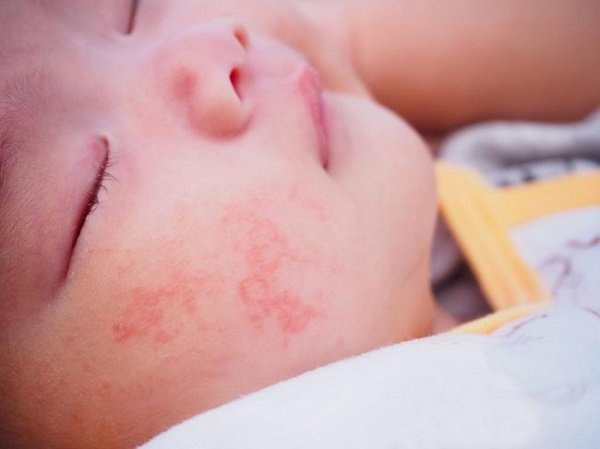 Tắm nắng sai cách và tác hại khôn lường đến làn da của trẻ em